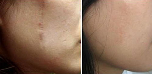 做完疤痕激光注意事項