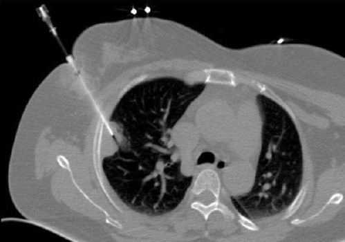 做肺部穿刺需注意事項