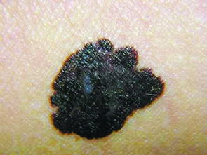 黑色素,切除,注意事項