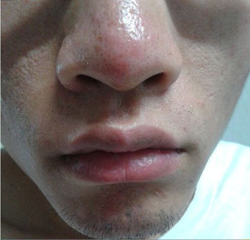 酒糟鼻子的注意事項(xiàng)