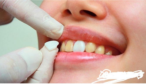 剛磨完牙注意事項,剛拔完牙注意事項,剛鑲完牙注意事項