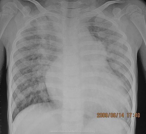 幼兒拍胸片注意事項(xiàng),兒童拍胸片的注意事項(xiàng),女性拍胸片注意事項(xiàng)