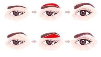 切眉提升術(shù)后注意事項(xiàng)