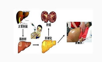 肝硬化,注意事項(xiàng),患者,飲食