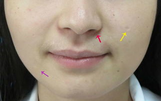 痣切除手術(shù)后注意事項,皮內(nèi)痣切除后注意事項,藍痣切除后的注意事項