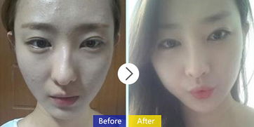 取完下巴假體注意事項,做了下巴假體注意事項,假體下巴術(shù)后注意事項