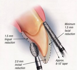 全瓷牙的注意事項(xiàng),全瓷牙安裝后注意事項(xiàng),全瓷牙戴牙后注意事項(xiàng)