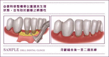 牙周病基礎(chǔ)知識講解